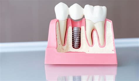 Possible Causes Of Dental Implant Failure Symptoms And Prevention