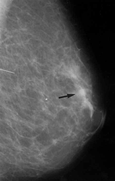 Reassessment Of Breast Cancers Missed During Routine Screening