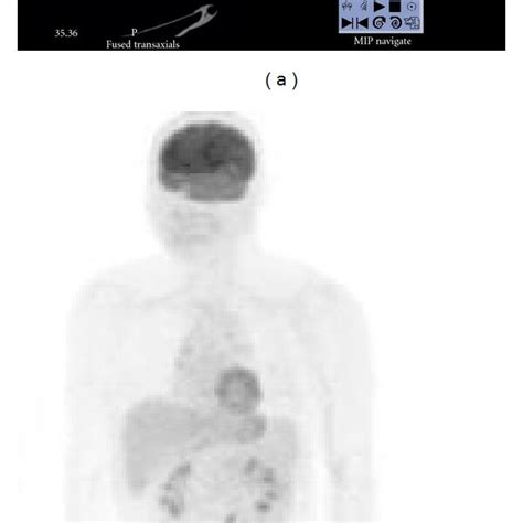 preoperative positron emission tomography a abnormal uptake download scientific diagram