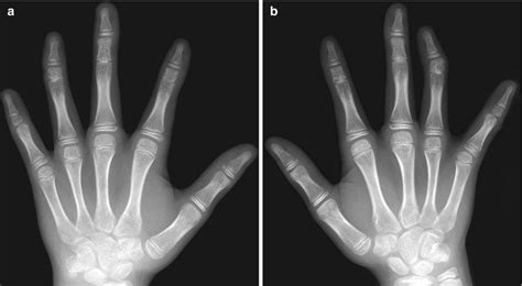 The Hand And Wrist Congenital And Developmental