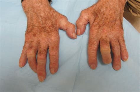 Osteoarthritis Fingerthumb Mp Pip Dip And Ip Hand Surgery Source