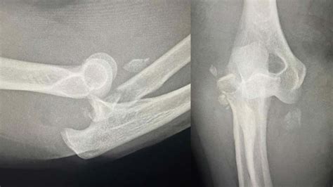 Case Study Terrible Triad Right Elbow Fracture Dislocation