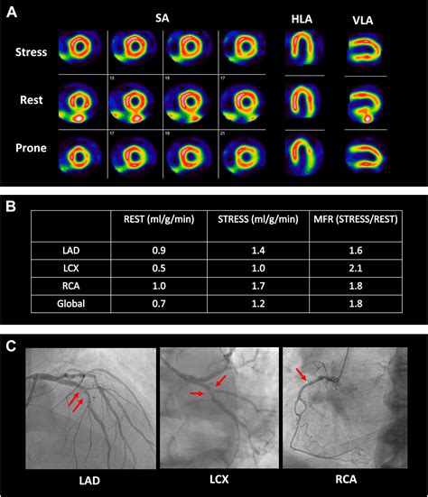 Advances In Single Photon Emission Computed Tomography Cardiology Clinics