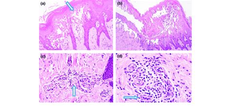 Histopathological Changes In The Epithelium Of The Pigs Infected