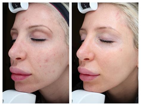 Before And After My Halo Laser Treatment Results — Med E Spa