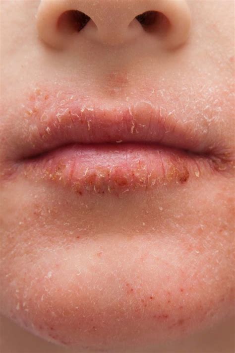 Dry face skin it can appear as a face rash, bumps dermatitis or even rosacea. Dry skin around the mouth: Causes, treatment, and remedies