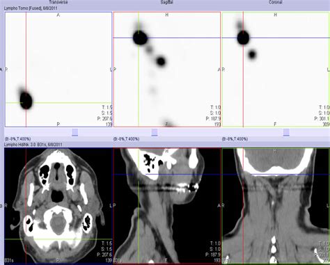 Case Example Sentinel Lymph Node Biopsy Iowa Head And Neck Protocols