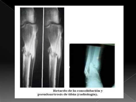 Factores Que Alteran La Consolidación ósea De Fracturas