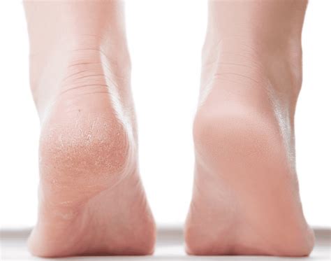 What Really Causes Cracked Heels And How To Heal Them Part I Gotham