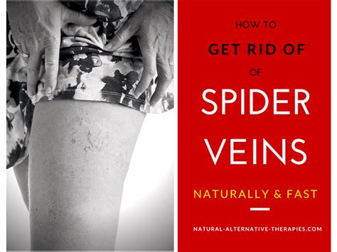How I Got Rid Of My Spider Veins In 2 Weeks Naturally