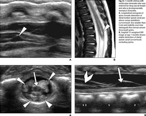 Figure 3—1 From Sonography Of The Neonatal Spine Part 1 Normal