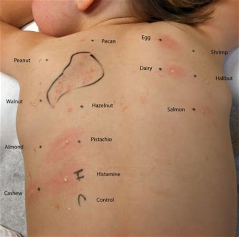 Maybe you would like to learn more about one of these? Allergy Testing for 1 year old -- What can I expect ...