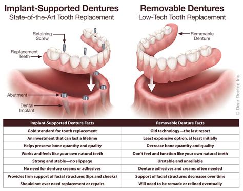 Fixed Dentures Dentistry And Orthodontics