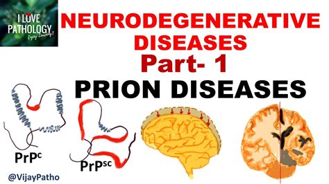Neurodegenerative Diseases Part 1 Prion Diseases Youtube