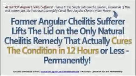 Angular Cheilitis Overnight Cure Angular Cheilitis Treatment Youtube