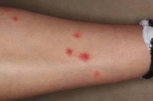 Cutaneous Reactions To Arthropod Bites Causes Symptoms And Treatment