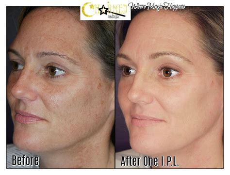 Intense Pulsed Light And Laser Therapies Charmed Medispa