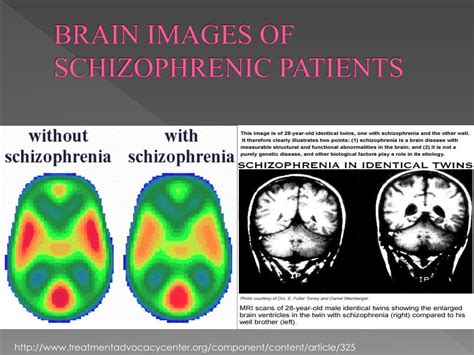 ppt schizophrenia and its biological basis powerpoint presentation free download id 5447556