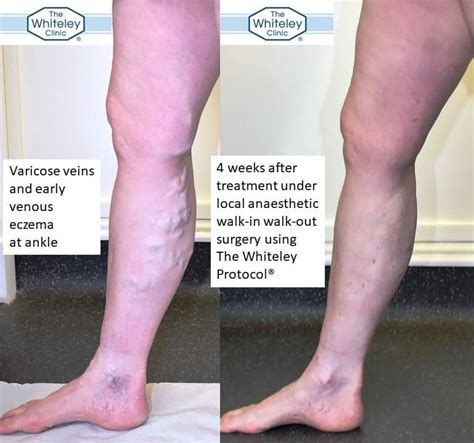 Walk In Walk Out Varicose Vein Surgery The Whiteley Clinic