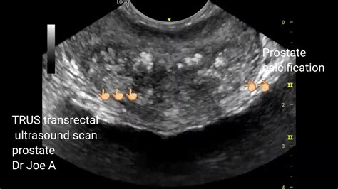 Prostate Calcification Trus Or Transrectal Ultrasound Video Youtube