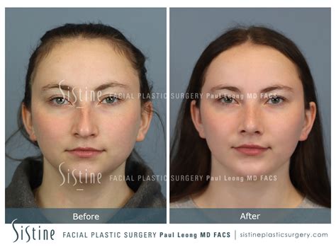 Chin Implant Before And After 01 Sistine Facial Plastic Surgery