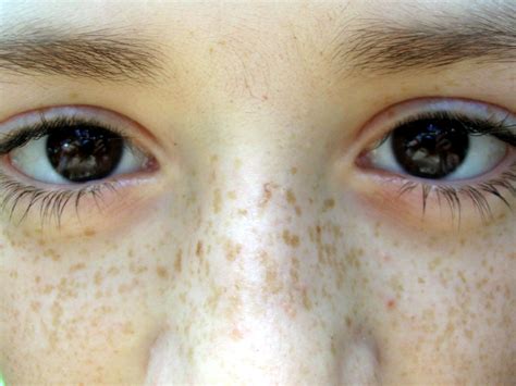 Freckles Vs Lentigines What Is The Difference In Two Medicalopedia