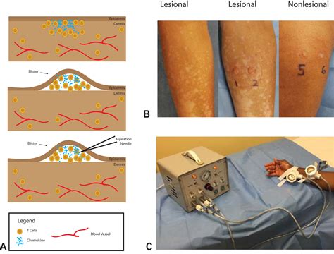 Suction Blistering The Lesional Skin Of Vitiligo Patients Reveals
