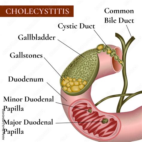 Vecteur Stock Сholecystitis Inflammation of the gallbladder and bile