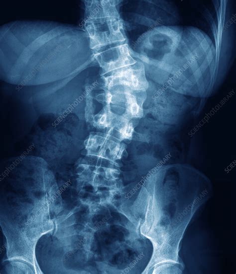 They are primarily spongy bone that is covered with a thin layer of compact bone. Broken back, X-ray - Stock Image M330/1307 - Science Photo Library