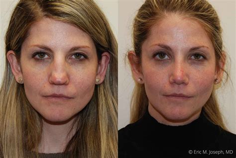 Eric M Joseph Md Rhinoplasty Before And After Nasal Narrowing And Tip Repair