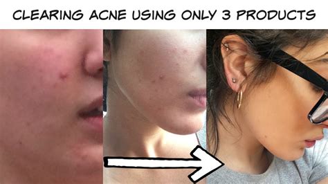 How I Cleared My HORMONAL ADULT ACNE Using Only AFFORDABLE Products I Best Routine And Tips