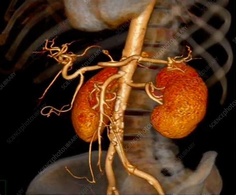 Healthy Kidneys 3d Ct Scan Stock Image C0529200 Science Photo