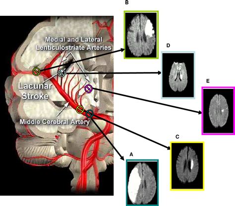 Pathophysiology Of Lacunar Stroke Ischaemic Stroke Or Blood Brain Barrier Dysfunction