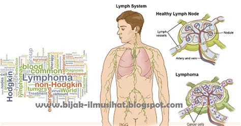 Cytokines dibebaskan oleh sistem imunisasi sebagai reaksi terhadap sel limfoma. Kanser Limfoma, Tanda-tanda, Penyebab dan Rawatannya ...