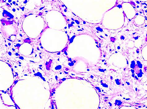 Pathology Outlines Lipoma