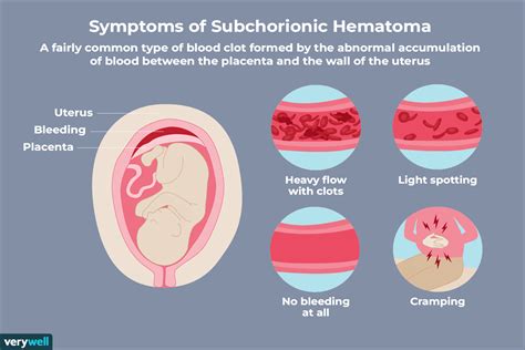 Hematoma Causes Symptoms Treatment Hematoma Symptoms In Tissues My