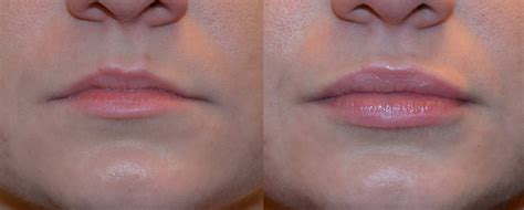 Lip Augmentation Before And After Juvederm The Image
