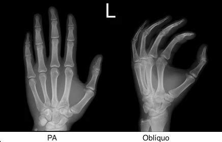 Radiografia de mão e do punho saiba mais Medway