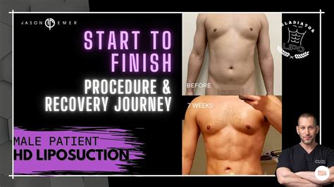 Male 360 Hd Lipo Gladiator Six Pack Start To Finish Procedure And Recovery Journey Youtube