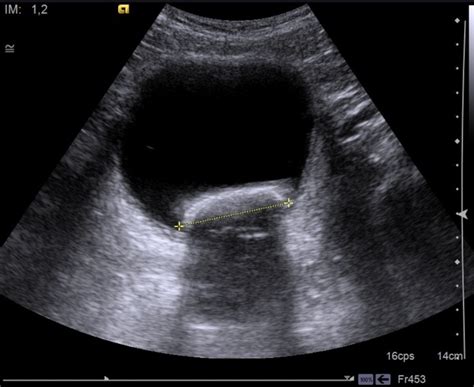 Bladder Stone Ultrasound
