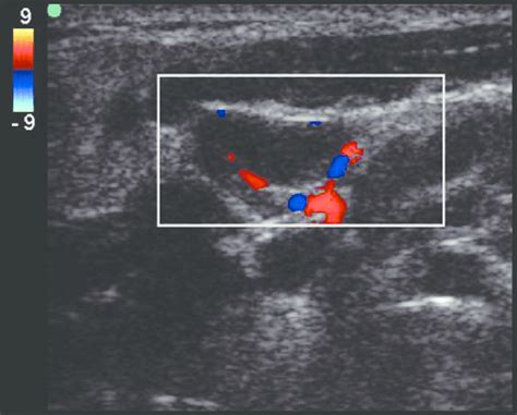 Color Doppler Ultrasound Image Of Benign Lymph Node Showing