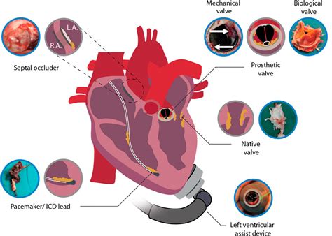 Frontiers Native Valve Prosthetic Valve And Cardiac Device Related