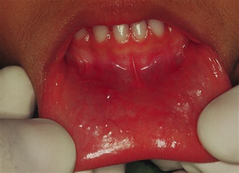 Retention Mucocele On The Lower Lip Associated With Inadequate Use Of