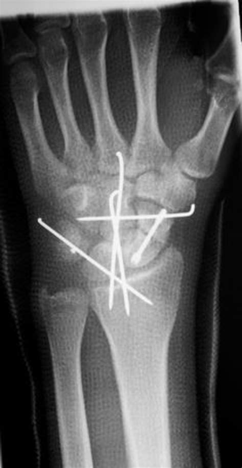 Wrist Pa X Ray Taken Post Operatively Download