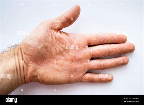 Dry Man Hand With Skin Peeling Off Stock Photo Alamy
