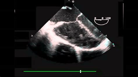 Primum Asd Transesophageal Echocardiogram Four Chamber View Youtube