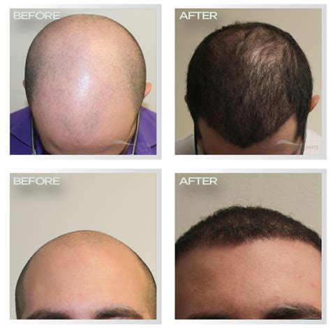 Best Hair Transplants Photo Actual Patient Results Hair Transplant