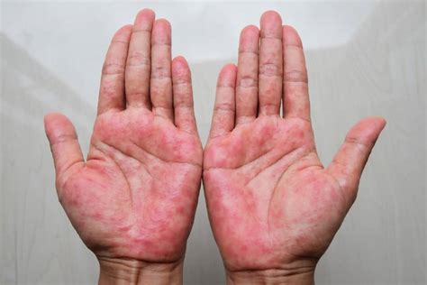 6 Types Of Eczema Which Do You Have Riverchase Dermatology