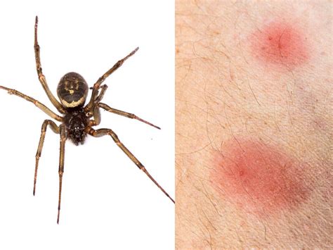 What Do Little Spider Bites Look Like What Does A Wolf Spider Bite