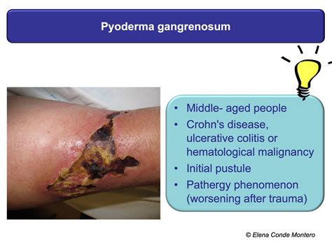 Necrosis And Purple Edges In Leg Ulcers Keys To Guide Your Diagnosis